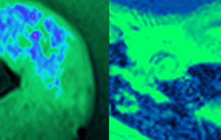 Towards entry "Patients suffering from severe chronic inflammatory develop osteoporosis"