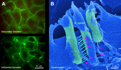 Towards entry "Helicobacter Pylori induces gastric cancer"